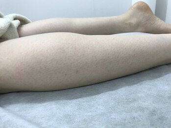 ナノハナ/鹿沼市の全身脱毛のナノハナ