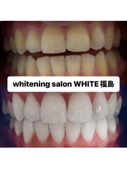 ホワイトニングサロン ホワイト(WHITE)/セルフホワイトニング効果