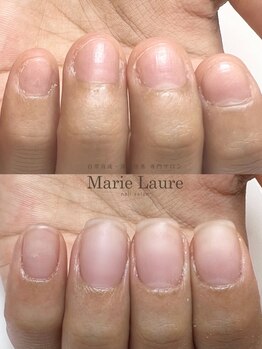 マリーロール 梅田店(Marie Laure)/自爪育成/深爪矯正/ネイルケア
