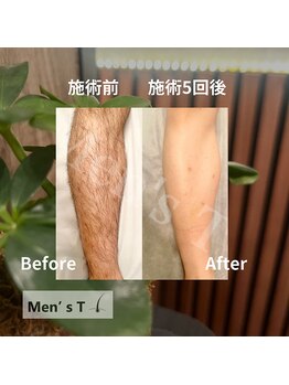 メンズ ティ(Men's T)/下半身脱毛