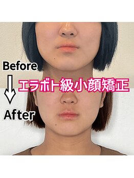 アコルデ 岡山問屋町(ACORDE)/小顔矯正ver.1