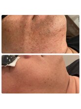 ラディエンス 多治見店/メンズ脱毛