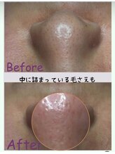 エヌ ドット ジュウイチ(N.11)/毛穴エクストラクション