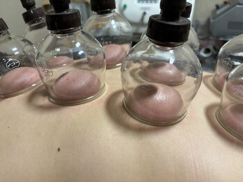 アーチ(AR-CH.)/カッピング