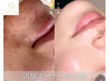 サロンエヌ 久留米店(Salon N)/ツルツル韓国美肌へ♪