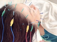 瑞 鍼灸院/頭皮鍼+美容鍼