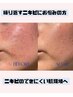 【ニキビでお悩みの方】ハーブピーリング-60分-