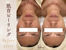 リボーン(Reborn)/肌育ピーリングでハリUPで若見え