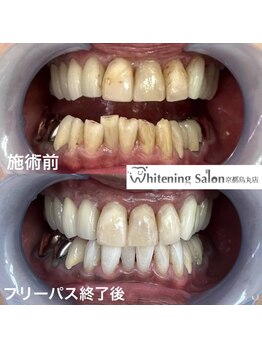 ホワイトニングサロン 京都烏丸店/ホワイトニング施術例