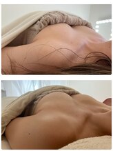 アンドモア(&more)/バストアップ症例