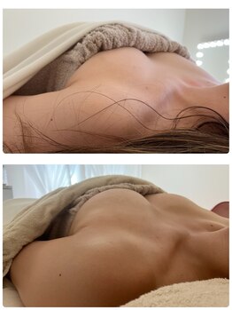 アンドモア(&more)/バストアップ症例