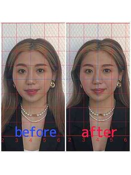 ルディア 堀江店(ledia)/美容鍼1回での変化
