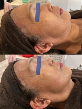 エステティックジュビラン アンビエンテ 福井南店/シミ、シワ、タルミケア