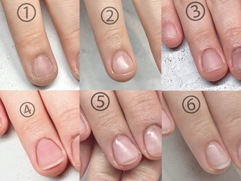 プチムトン 鶯谷店(petit mouton)/【深爪矯正コース】5