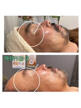 ココ 2号店(CoCo)/男性も美肌ホワイトスノーピール