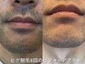 【人気No.1★メンズ脱毛】ヒゲ脱毛 ￥5,500