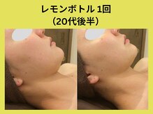 アユアランリンク 札幌店/レモンボトル/20代/1回