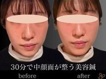 チョコバリ 郡山店(chocobari)/小顔×リフトアップ(美容鍼)20代