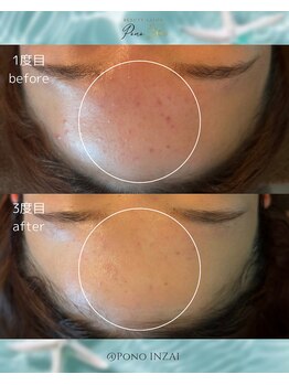 ポノ(Pono)/3回目のBefore/After☆