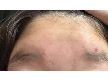 メナードフェイシャルサロン 伊那狐島/ニキビケアはご自宅でのW洗顔！