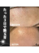 ラトワ(LATOWA)/棘あり　ハードハーブ