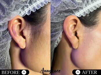 アングレイス(Anngrace)/