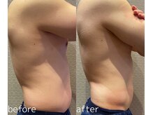 ビュウナ 銀座(BEAUNA)/脂肪冷却/frozen8