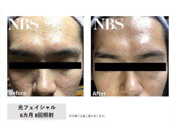 マイプラ(mypla)/光フェイシャル「ニキビ」