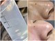 Lier&の写真/【三条駅2分/毛穴洗浄】その場でわかる即時効果◎REDSHOTとの掛け合わせでツヤ肌とリフトアップを叶える★