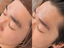 エムズハグ(M's hug)/眉毛WAX/10代/自己処理が苦手…