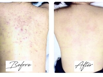 ビズビズ 天王寺店(bisebise)/<症例>背中ニキビケア・跡