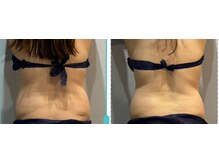 ラヴィエール(Laviere)/レディース痩身120分