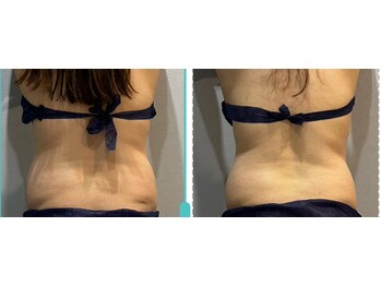 ラヴィエール(Laviere)/レディース痩身120分