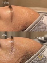 ラヴィス(RAVIS)/次世代ラミネーションピール