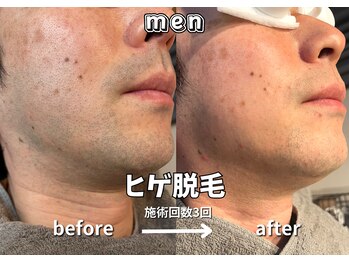 キュー(cue)/【メンズ】「ヒゲ脱毛」3回