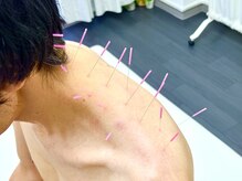 とだ鍼灸院/《鍼灸施術》首肩レスキュー鍼灸