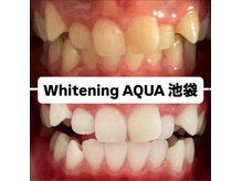 アクア 池袋店(AQUA)/ホワイトニング/池袋/東京/美白