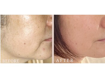 ロジワール(LOISIR)/横顔フェイスラインの変化