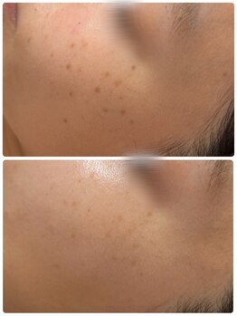 ソレラ(sorelle)/シミケア