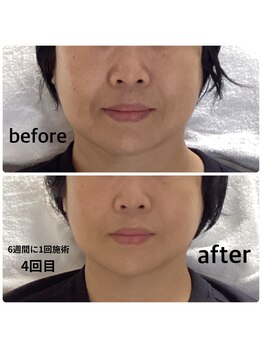 アキ/6週ごとの施術4回目の効果