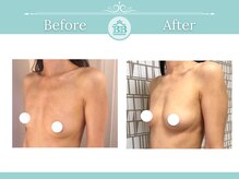 美人バスト 渋谷店/【バストアップ☆育乳】症例☆