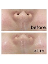 リアン(Lien)/1度でもこの効果◎毛穴悩みに