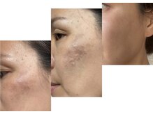 オルズ(Olu's)/ハーブピーリング｜シミケア