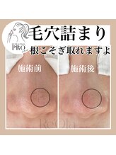 ニュートラル(neutral)/毛穴エクストラクションプロ大分