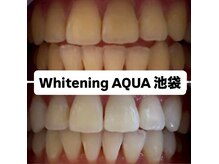 アクア 池袋店(AQUA)/ホワイトニング/池袋/東京/美白