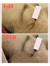 マールム(MALUM)/レチノール×ピーリング