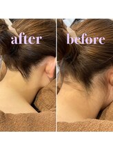 ナンバー511(No.511)/うなじ脱毛