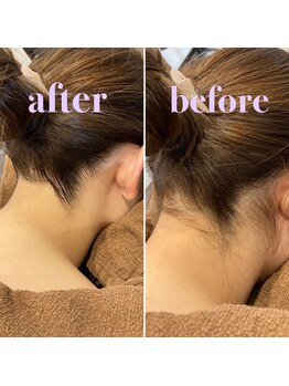 ナンバー511(No.511)/うなじ脱毛