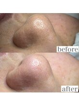 ライカブルー(RaicA BluE)/施術写真　before-after