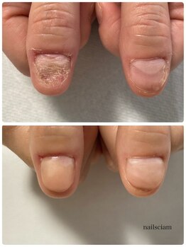 深爪矯正 即日見た目改善